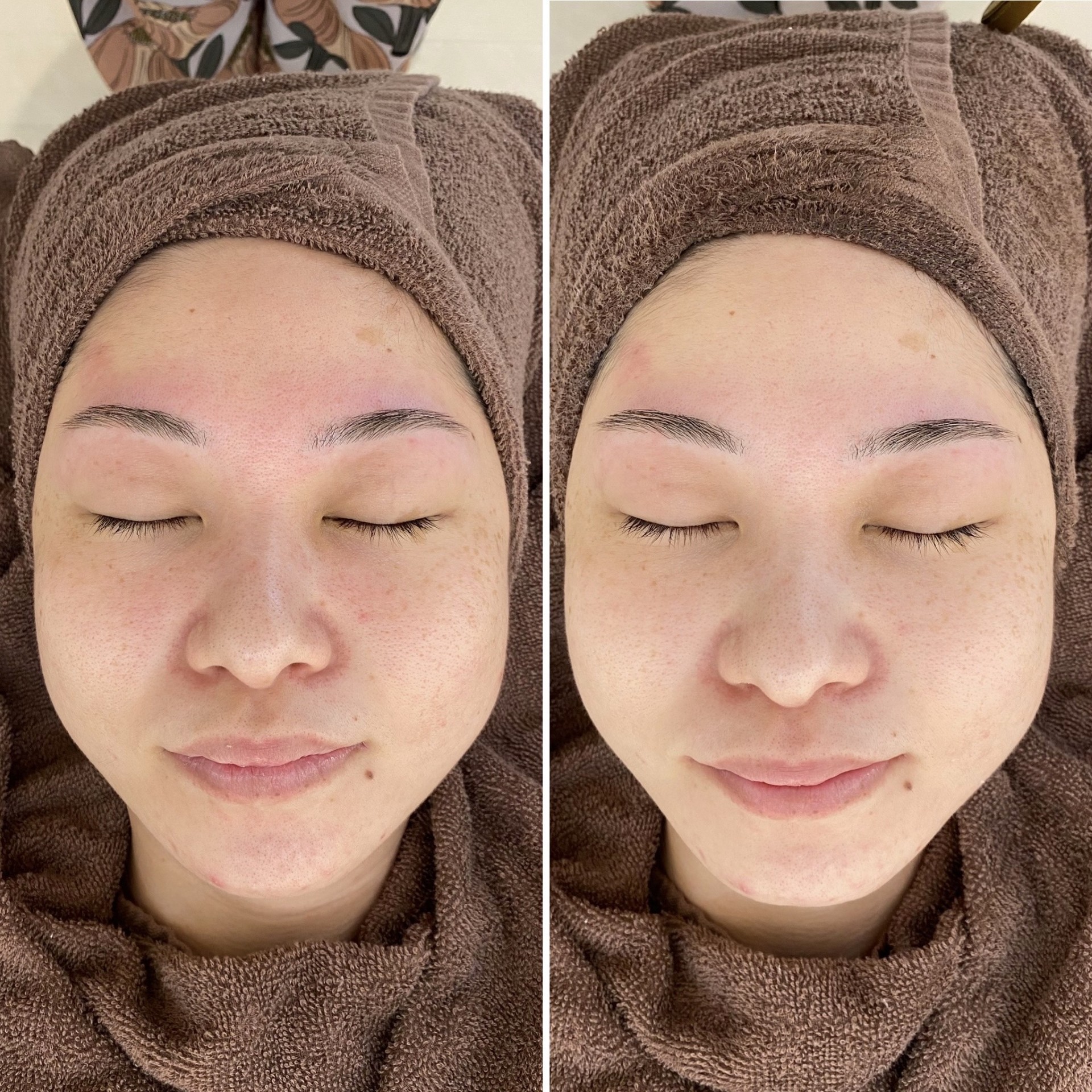 ハーブビフォーアフター写真